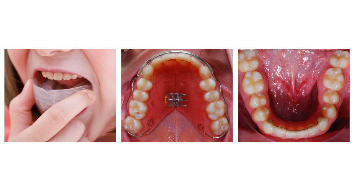 apparecchi ortodontici di contenzione